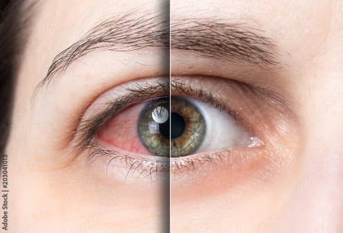 Pink Eye Treatment