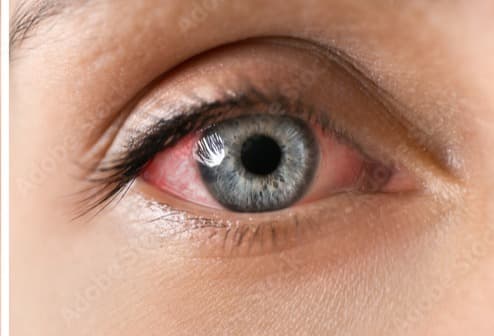 Uveitis Treatment