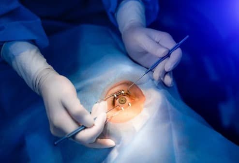 Cataract Surgery