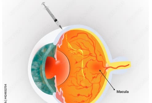 Macular Degeneration Treatment