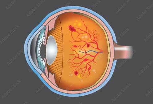 Diabetic Retinopathy Treatment